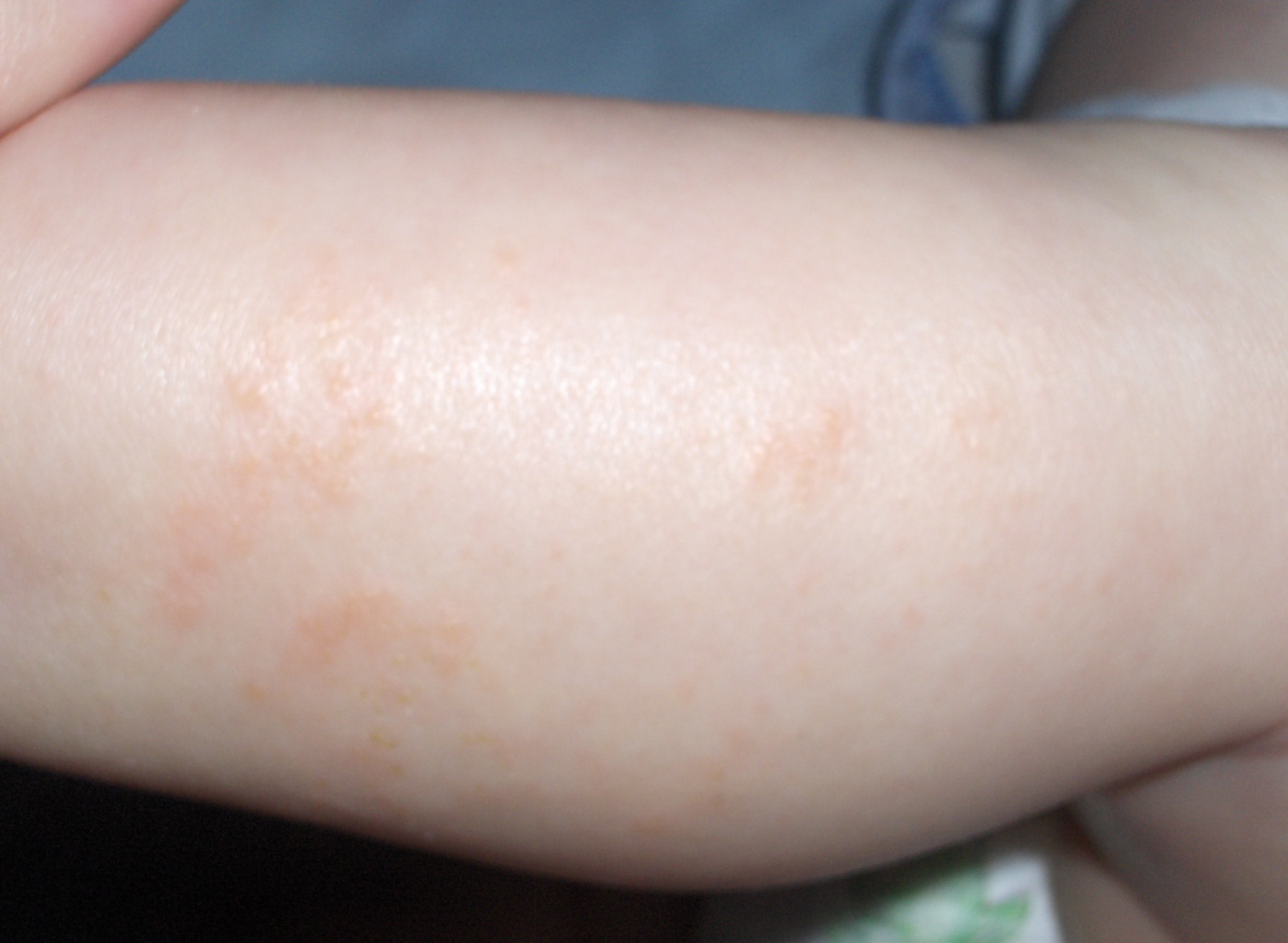 Psoriasis vs Eczema Pictures - Healthline